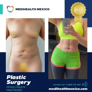 Plastic Procedure Before and After, MediHealth Mexico