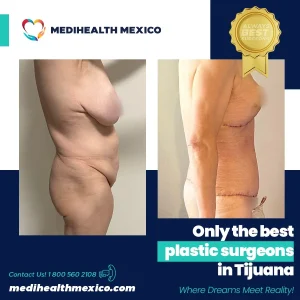 Plastic Procedure Before and After, MediHealth Mexico