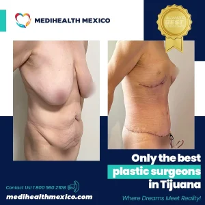 Plastic Procedure Before and After, MediHealth Mexico