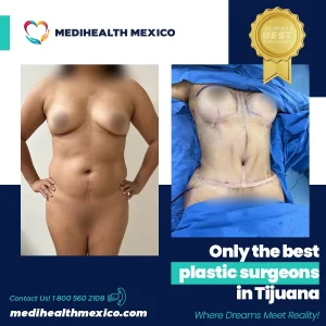 Plastic Procedure Before and After, MediHealth Mexico
