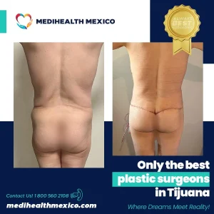 Plastic Procedure Before and After, MediHealth Mexico
