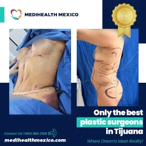 Plastic Procedure Before and After, MediHealth Mexico