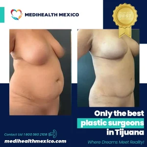 Plastic Procedure Before and After, MediHealth Mexico