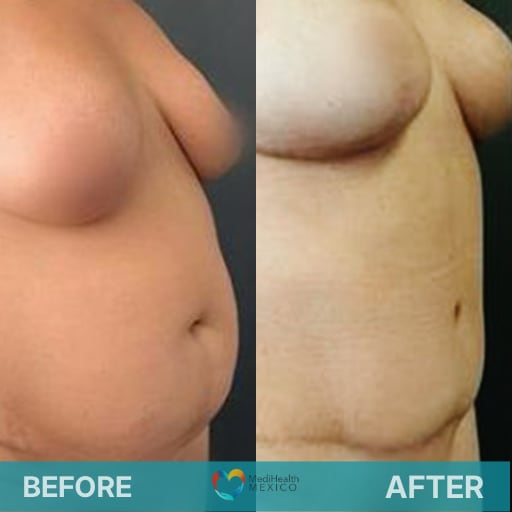 Restore your figure and confidence after pregnancy with a personalized combination of procedures on a Mommy Makeover Surgery