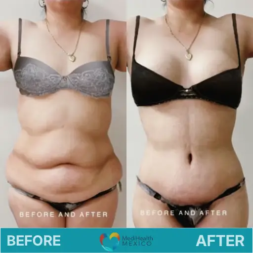 Restore your figure and confidence after pregnancy with a personalized combination of procedures on a Mommy Makeover Surgery