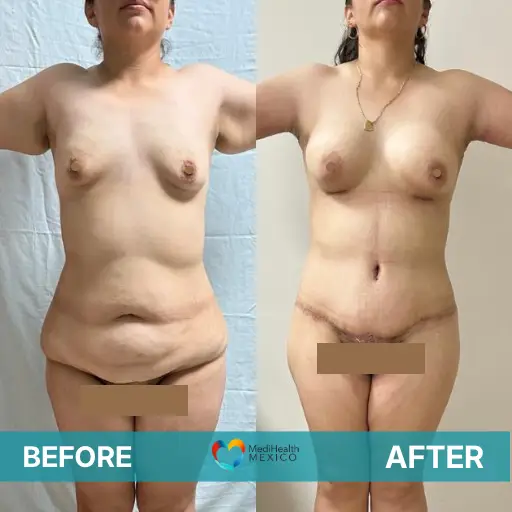 Restore your figure and confidence after pregnancy with a personalized combination of procedures on a Mommy Makeover Surgery