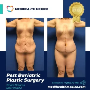 Plastic Procedure Before and After, MediHealth Mexico