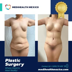 Plastic Procedure Before and After, MediHealth Mexico