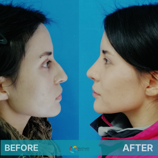 RHINOPLASTY