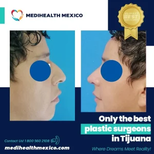 Plastic Procedure Before and After, MediHealth Mexico