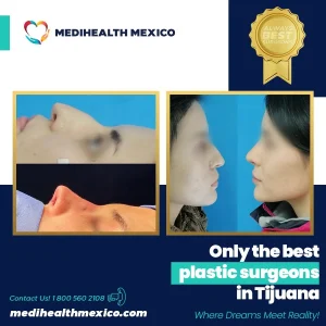 Plastic Procedure Before and After, MediHealth Mexico