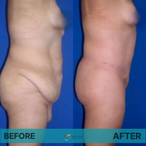 Tummy Tuck Before and After