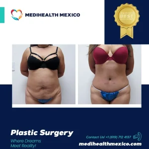 Plastic Procedure Before and After, MediHealth Mexico
