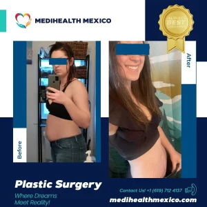 Plastic Procedure Before and After, MediHealth Mexico