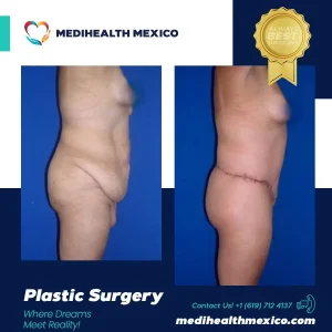 Plastic Procedure Before and After, MediHealth Mexico