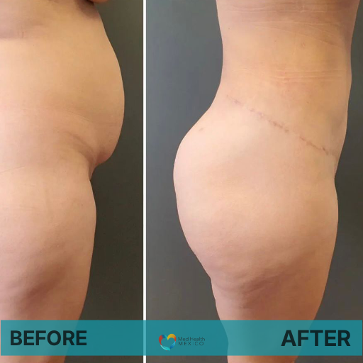 Tummy Tuck Before and After