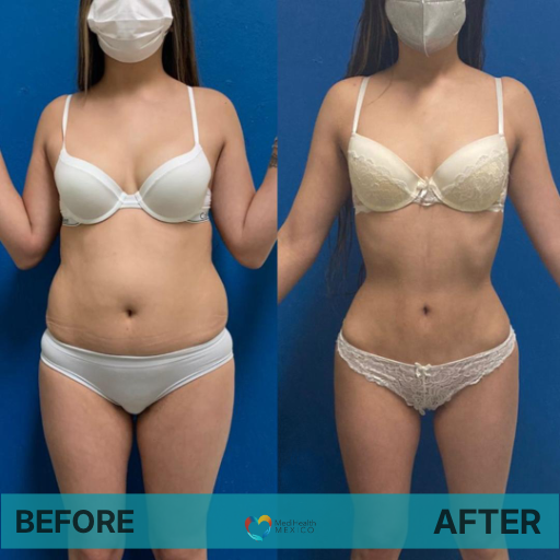 Tummy Tuck Before and After