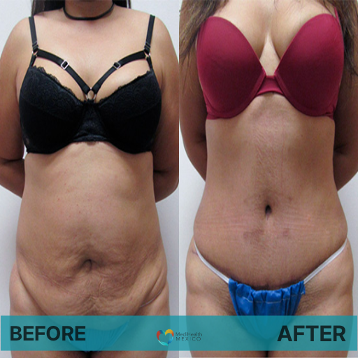 TUMMY TUCK: Before and After Plastic Procedures