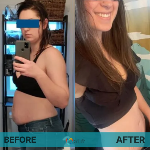 TUMMY TUCK: Before and After Plastic Procedures