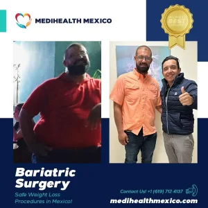Bariatric Procedure Before and After, MediHealth Mexico