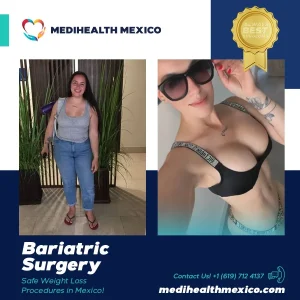 Bariatric Procedure Before and After, MediHealth Mexico