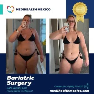 Bariatric Procedure Before and After, MediHealth Mexico