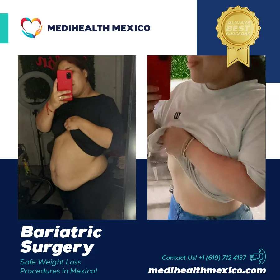 Bariatric Procedure Before and After, MediHealth Mexico