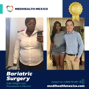 Bariatric Procedure Before and After, MediHealth Mexico