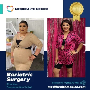 Bariatric Procedure Before and After, MediHealth Mexico