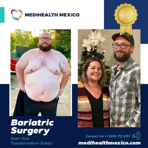 Bariatric Procedure Before and After, MediHealth Mexico