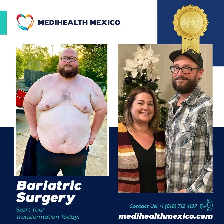 Bariatric Procedure Before and After, MediHealth Mexico