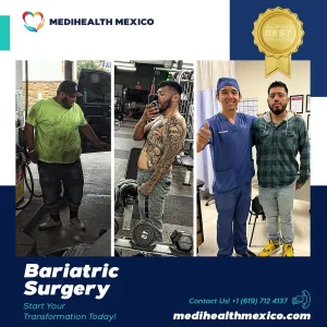 Bariatric Procedure Before and After, MediHealth Mexico