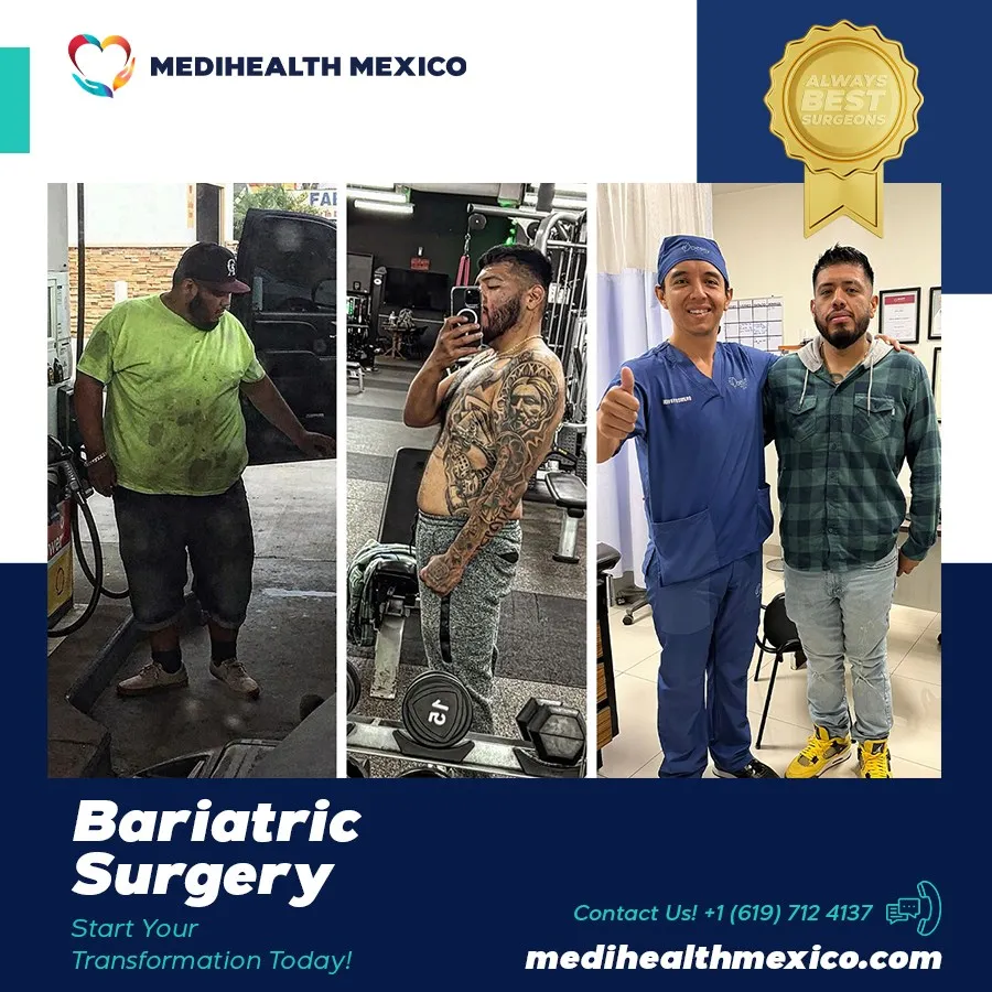 Bariatric Procedure Before and After, MediHealth Mexico