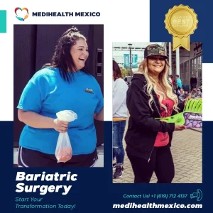Bariatric Procedure Before and After, MediHealth Mexico