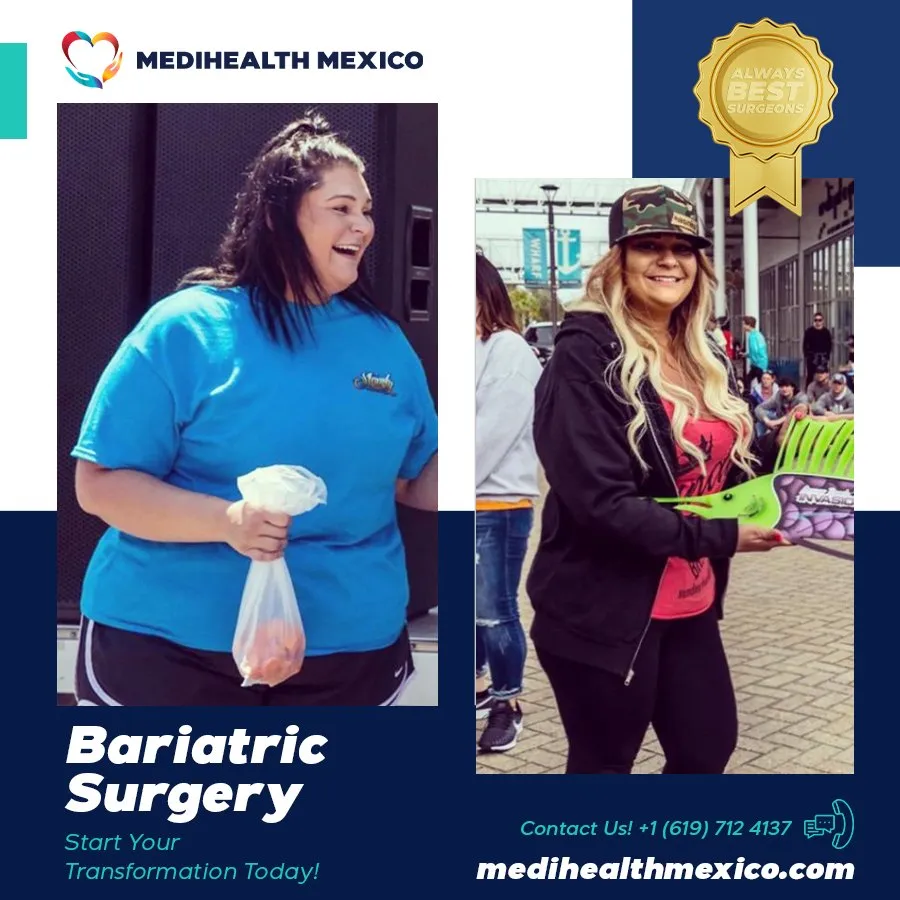 Bariatric Procedure Before and After, MediHealth Mexico