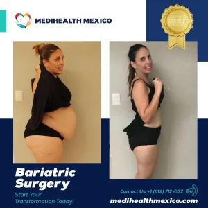 Bariatric Procedure Before and After, MediHealth Mexico
