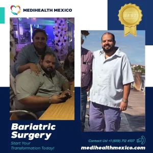 Bariatric Procedure Before and After, MediHealth Mexico