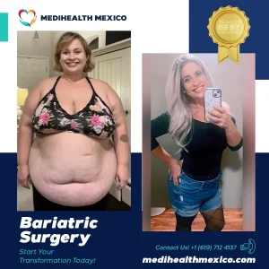 Bariatric Procedure Before and After, MediHealth Mexico