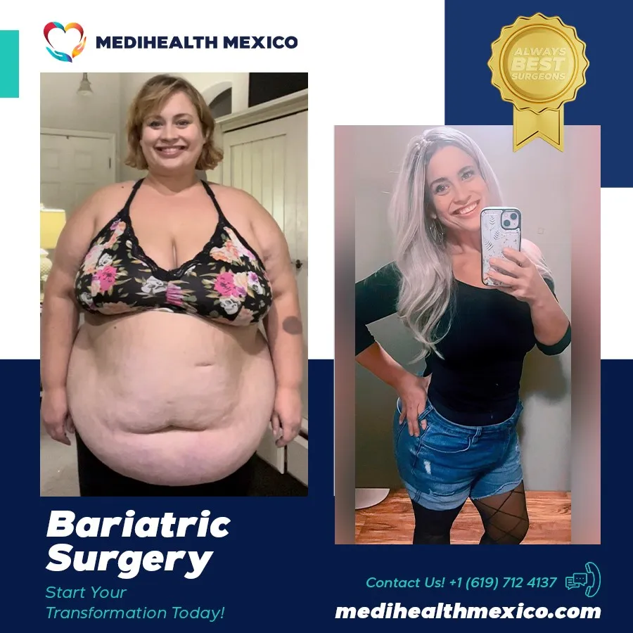 Bariatric Procedure Before and After, MediHealth Mexico