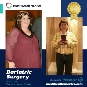Bariatric Procedure Before and After, MediHealth Mexico