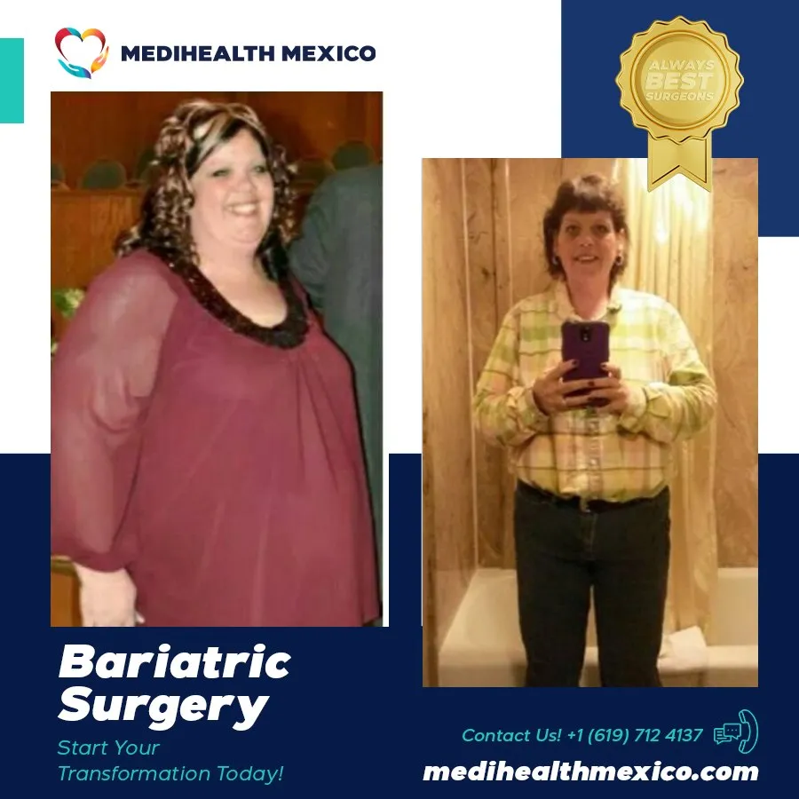 Bariatric Procedure Before and After, MediHealth Mexico