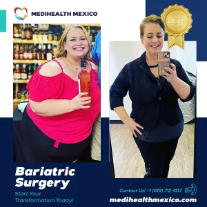 Bariatric Procedure Before and After, MediHealth Mexico