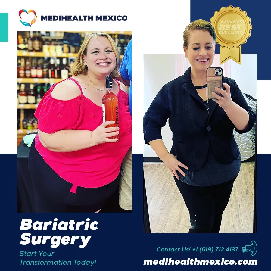 Bariatric Procedure Before and After, MediHealth Mexico