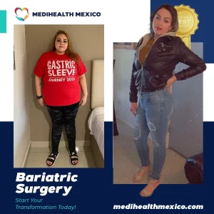 Bariatric Procedure Before and After, MediHealth Mexico