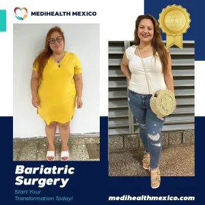 Bariatric Procedure Before and After, MediHealth Mexico