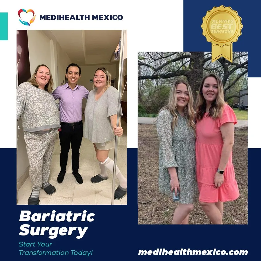 Bariatric Procedure Before and After, MediHealth Mexico