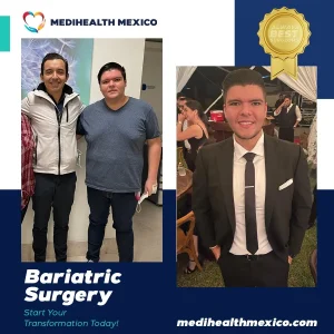 Bariatric Procedure Before and After, MediHealth Mexico