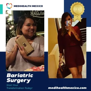 Bariatric Procedure Before and After, MediHealth Mexico