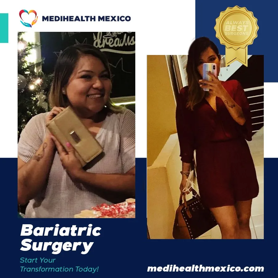 Bariatric Procedure Before and After, MediHealth Mexico