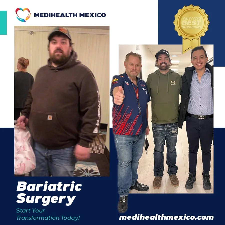 Bariatric Procedure Before and After, MediHealth Mexico